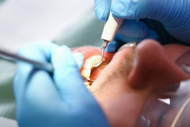 Best Emergency Dentist for Knocked-Out Tooth in Painesville, OH